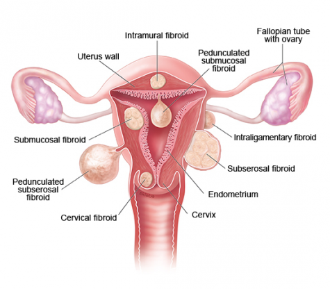 A-GUIDE-FOR-EVERY-WOMAN-ABOUT-UTERINE-FIBROIDS