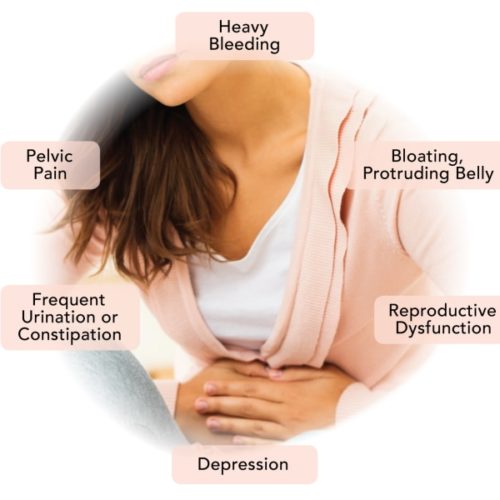 Fibroid-symptoms